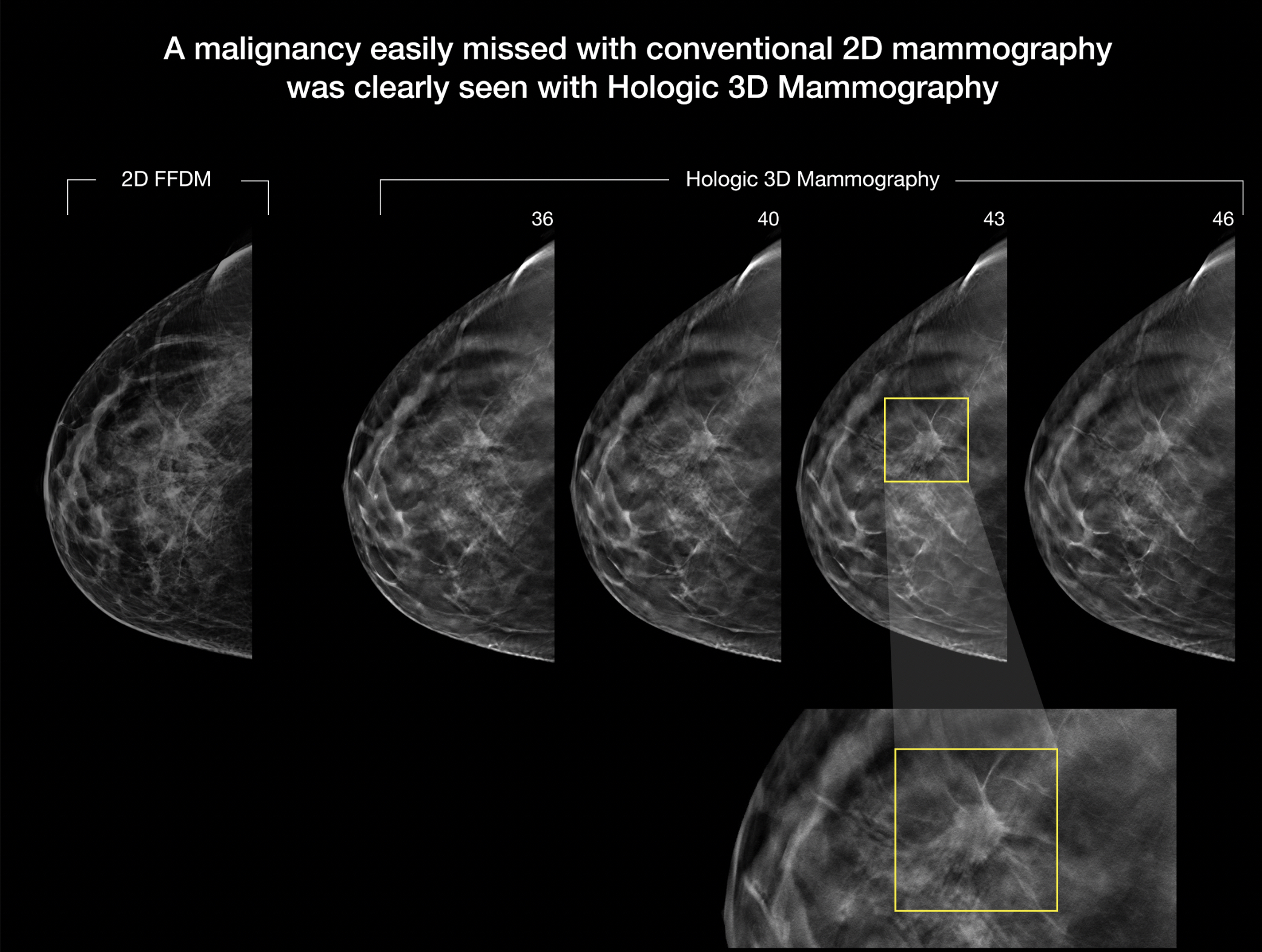 4 key trends in breast imaging